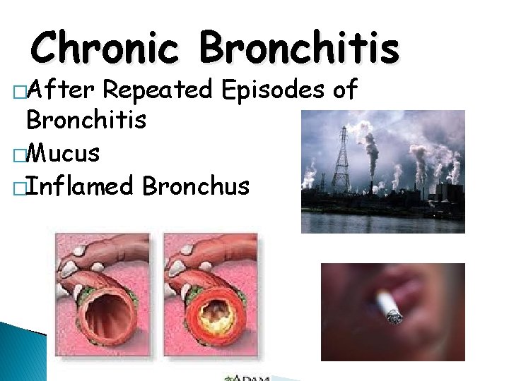 Chronic Bronchitis �After Repeated Episodes of Bronchitis �Mucus �Inflamed Bronchus 