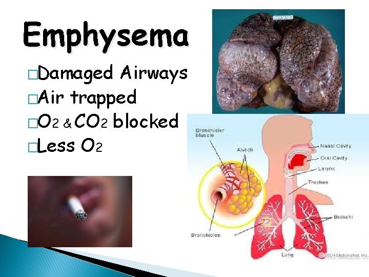 Emphysema �Damaged Airways �Air trapped �O 2 & CO 2 blocked �Less O 2