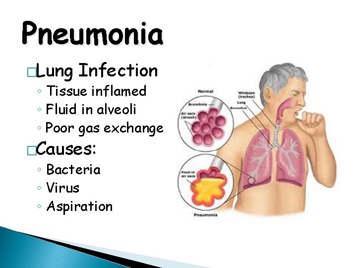Pneumonia �Lung Infection ◦ Tissue inflamed ◦ Fluid in alveoli ◦ Poor gas exchange