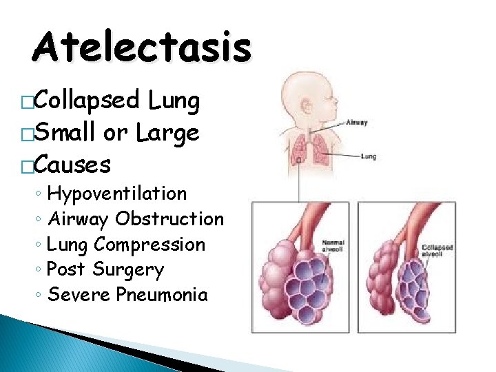 Atelectasis �Collapsed Lung �Small or Large �Causes ◦ Hypoventilation ◦ Airway Obstruction ◦ Lung