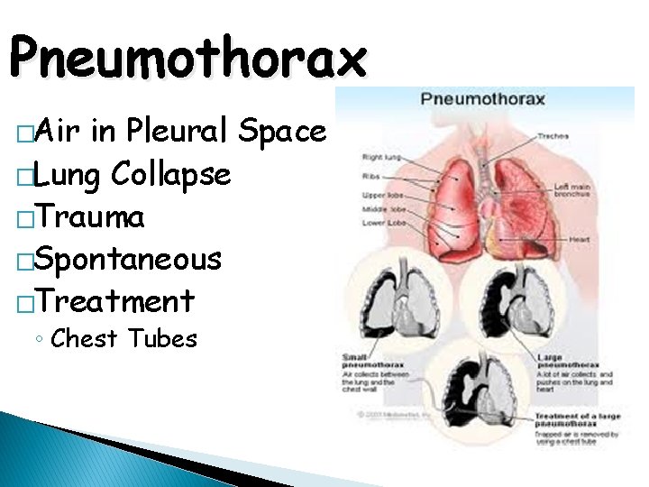 Pneumothorax �Air in Pleural Space �Lung Collapse �Trauma �Spontaneous �Treatment ◦ Chest Tubes 