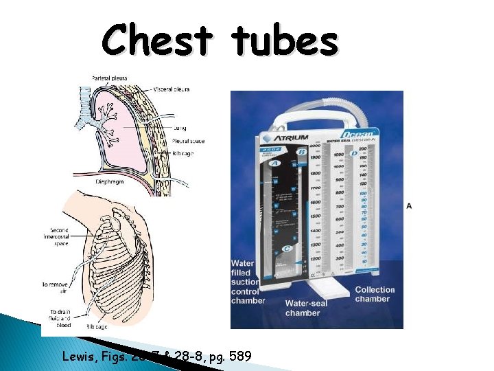 Chest tubes Lewis, Figs. 28 -7 & 28 -8, pg. 589 