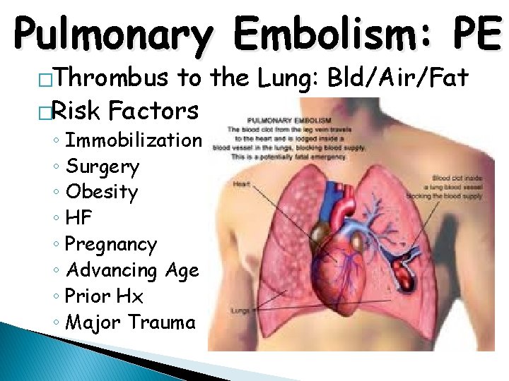 Pulmonary Embolism: PE �Thrombus to the Lung: Bld/Air/Fat �Risk Factors ◦ Immobilization ◦ Surgery