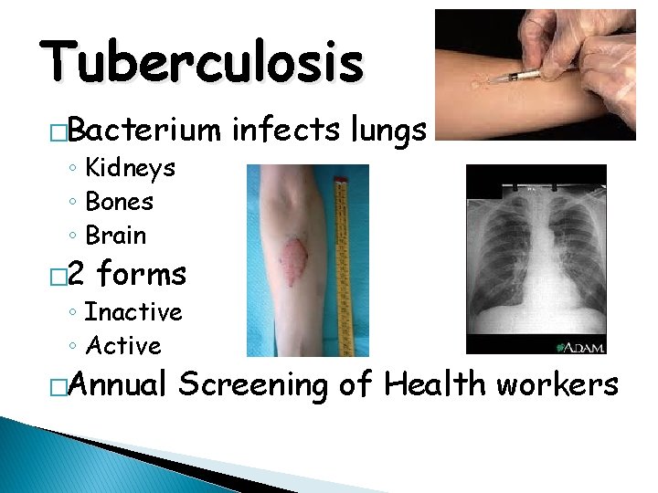 Tuberculosis �Bacterium ◦ Kidneys ◦ Bones ◦ Brain � 2 infects lungs forms ◦