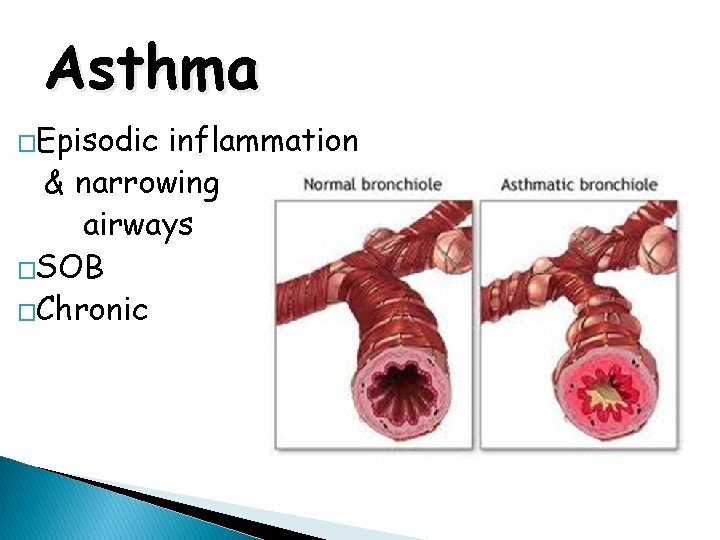 Asthma �Episodic inflammation & narrowing airways �SOB �Chronic 