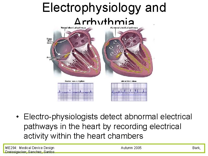 Electrophysiology and Arrhythmia • Electro-physiologists detect abnormal electrical pathways in the heart by recording