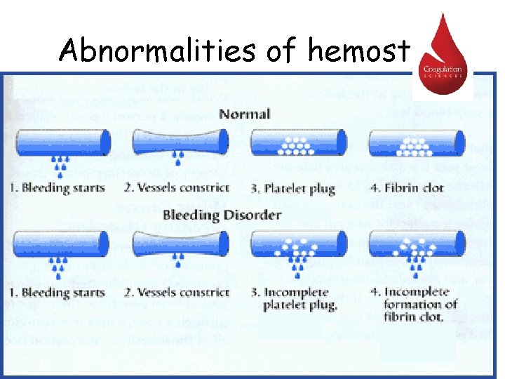 Abnormalities of hemostasis 
