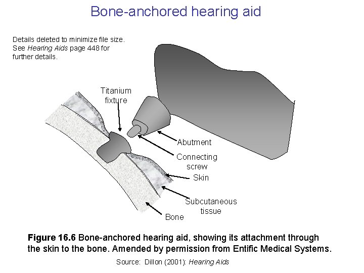 Bone-anchored hearing aid Details deleted to minimize file size. See Hearing Aids page 448