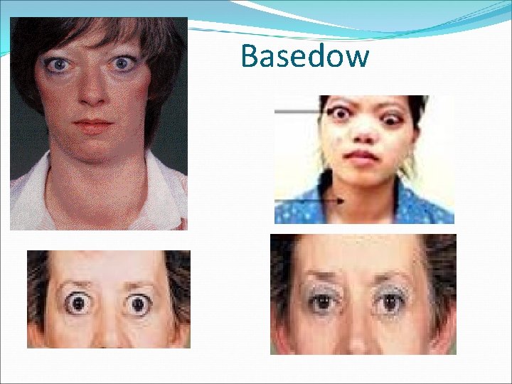 Basedow 