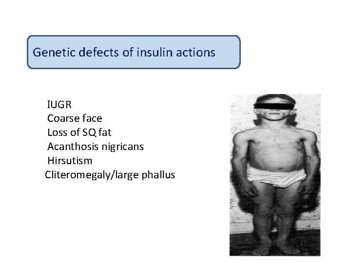 Genetic defects of insulin actions IUGR Coarse face Loss of SQ fat Acanthosis nigricans