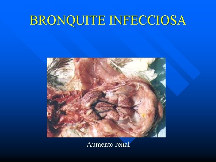 BRONQUITE INFECCIOSA Aumento renal 
