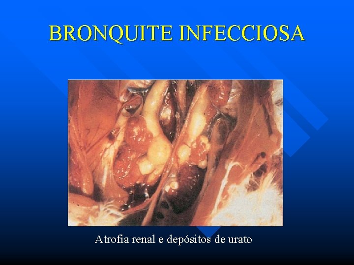 BRONQUITE INFECCIOSA Atrofia renal e depósitos de urato 