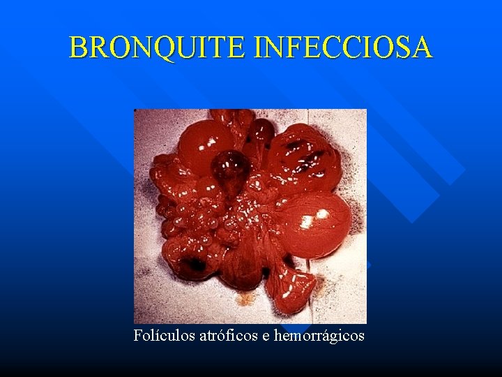 BRONQUITE INFECCIOSA Folículos atróficos e hemorrágicos 