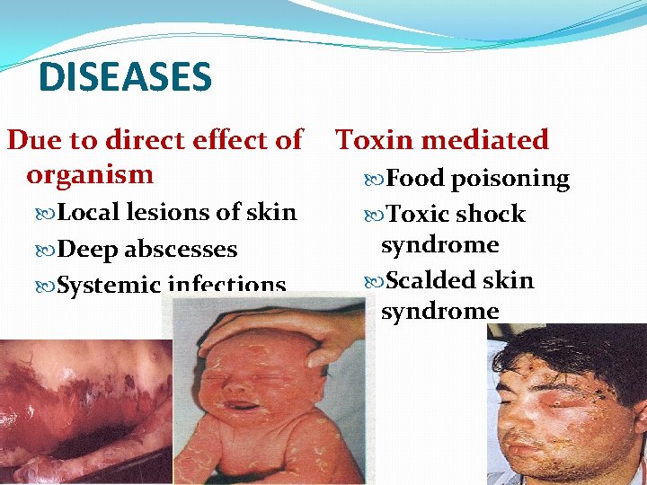 DISEASES Due to direct effect of organism Local lesions of skin Deep abscesses Systemic