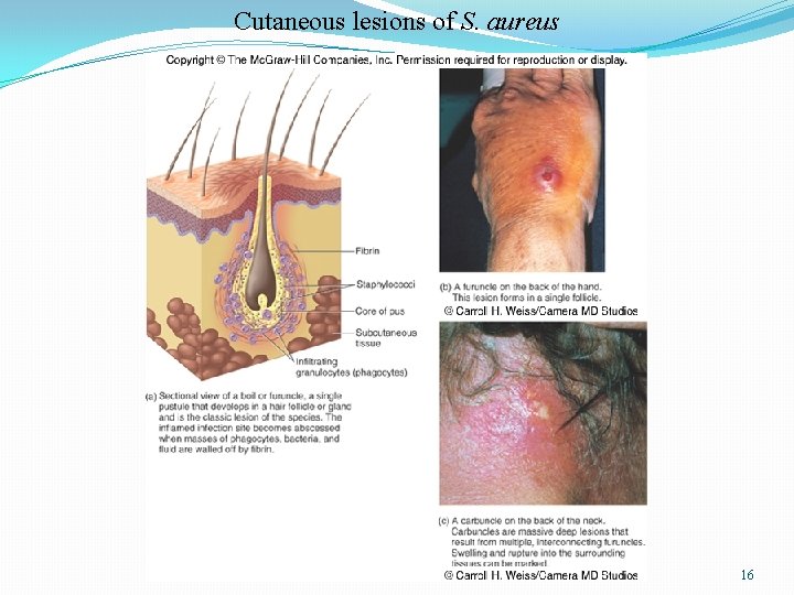 Cutaneous lesions of S. aureus 16 