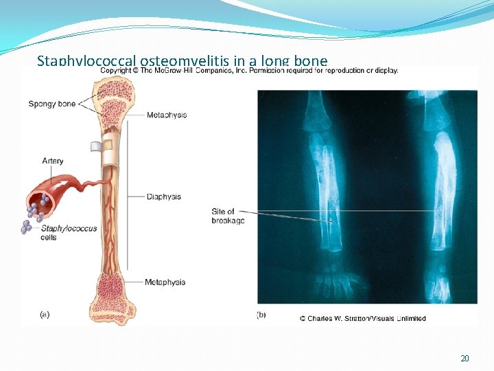 Staphylococcal osteomyelitis in a long bone 20 