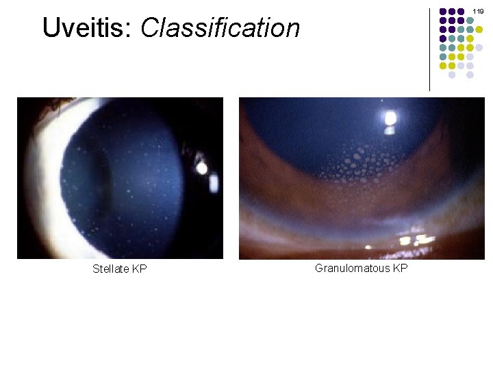 119 Uveitis: Classification Stellate KP Granulomatous KP 