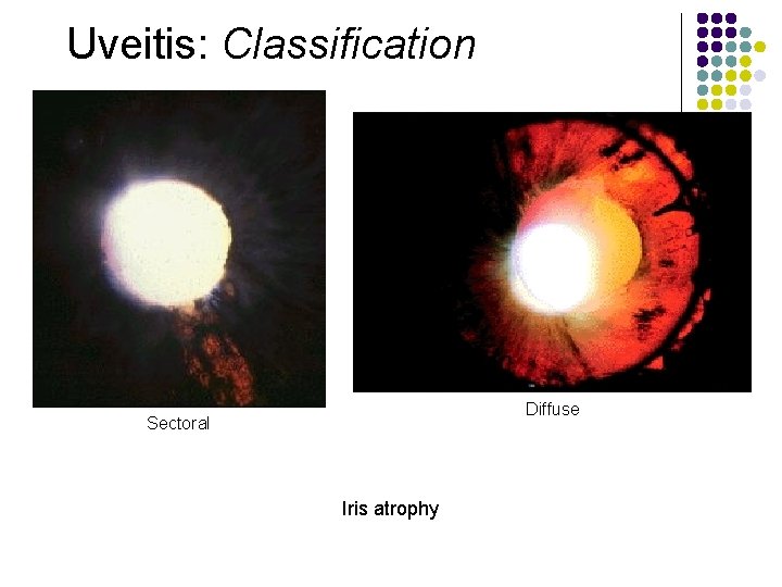 Uveitis: Classification Diffuse Sectoral Iris atrophy 