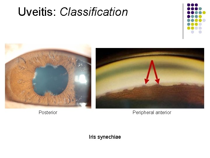 Uveitis: Classification Posterior Peripheral anterior Iris synechiae 