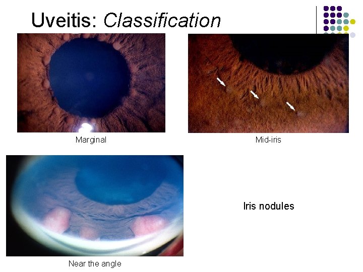Uveitis: Classification Marginal Mid-iris Iris nodules Near the angle 