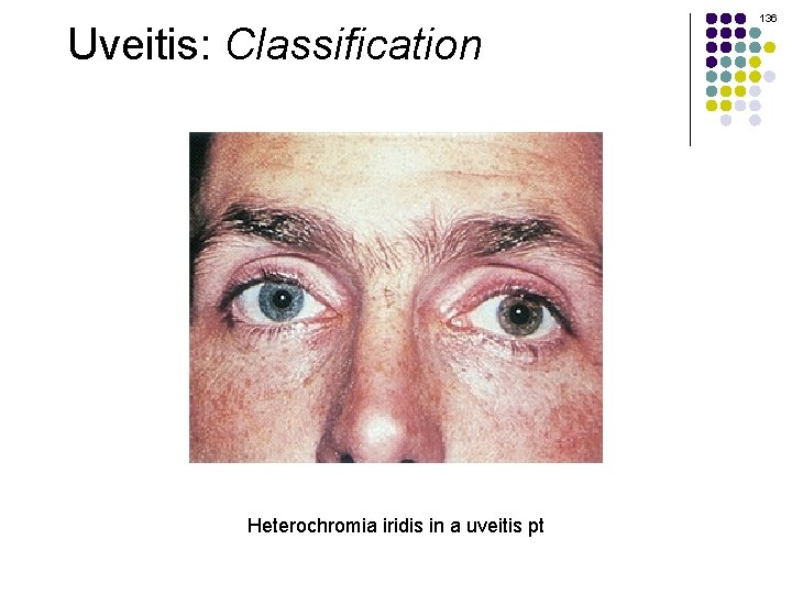 Uveitis: Classification Heterochromia iridis in a uveitis pt 136 