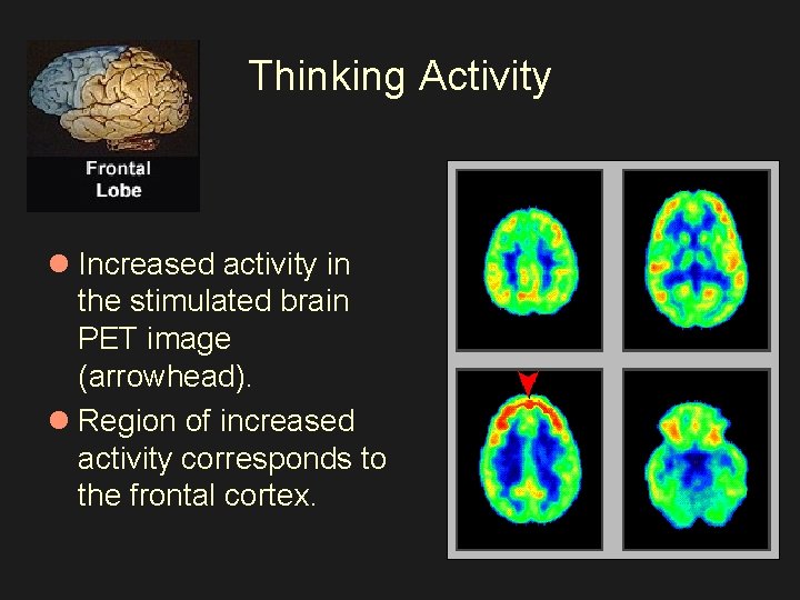 Thinking Activity l Increased activity in the stimulated brain PET image (arrowhead). l Region