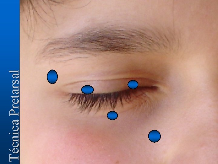 Técnica Pretarsal 
