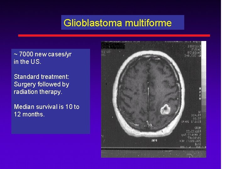 Glioblastoma multiforme ~ 7000 new cases/yr in the US. Standard treatment: Surgery followed by