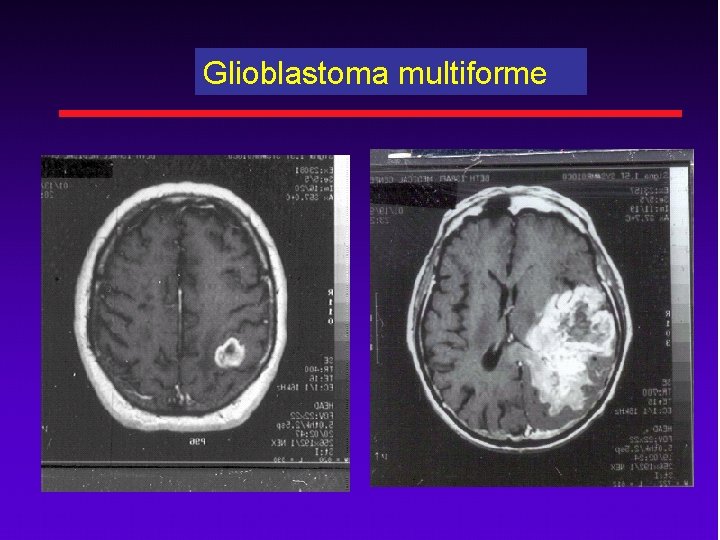 Glioblastoma multiforme 