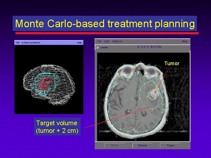Monte Carlo-based treatment planning Tumor Target volume (tumor + 2 cm) 