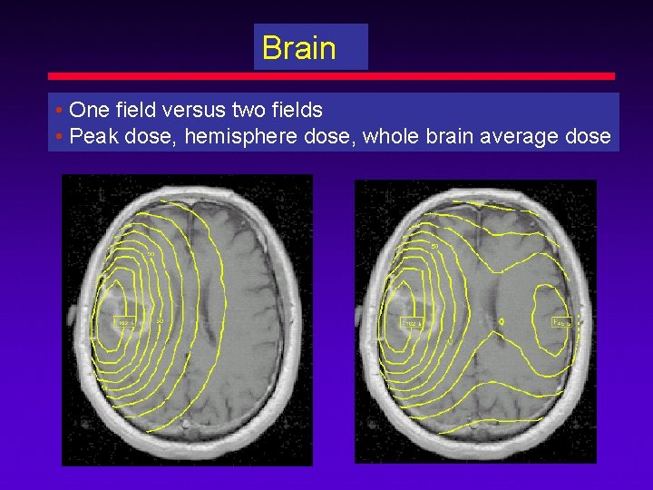 Brain • One field versus two fields • Peak dose, hemisphere dose, whole brain