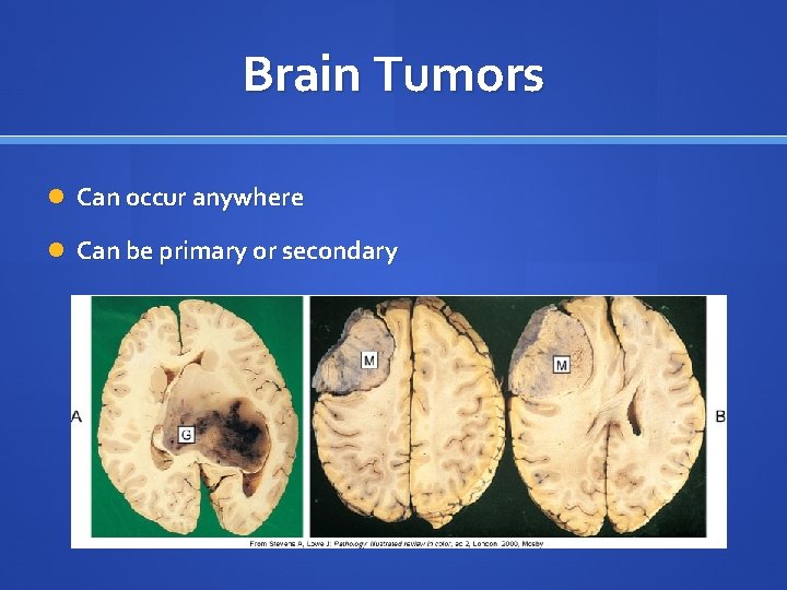 Brain Tumors Can occur anywhere Can be primary or secondary 