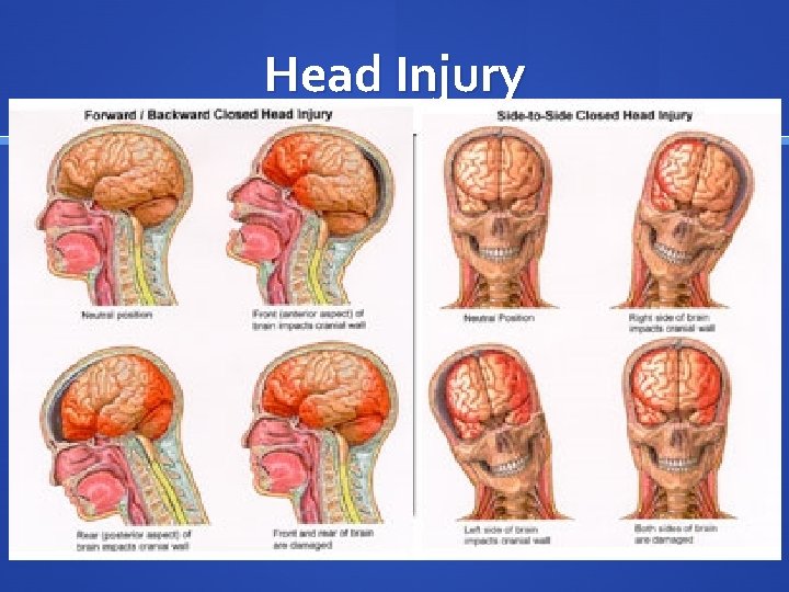 Head Injury 