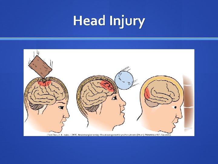 Head Injury 