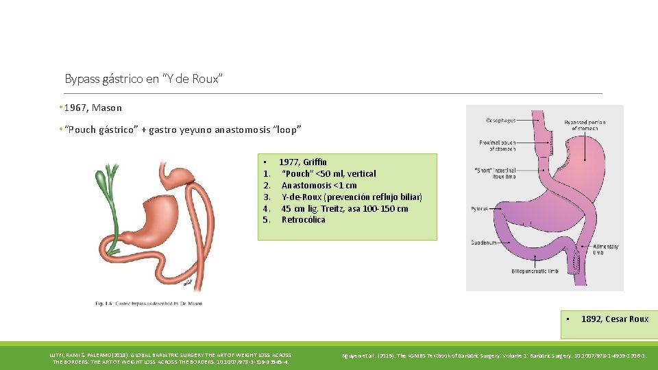 Bypass gástrico en “Y de Roux” • 1967, Mason • “Pouch gástrico” + gastro