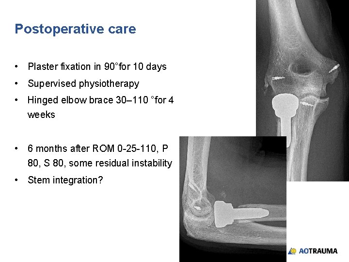 Postoperative care • Plaster fixation in 90°for 10 days • Supervised physiotherapy • Hinged