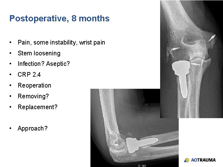 Postoperative, 8 months • Pain, some instability, wrist pain • Stem loosening • Infection?