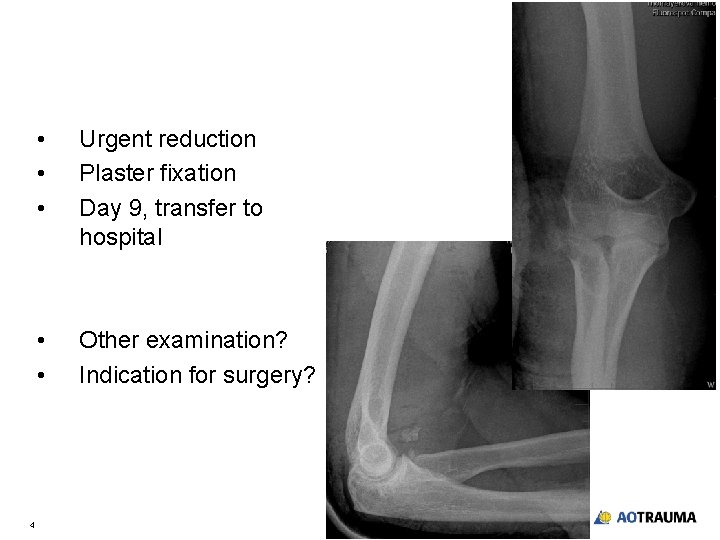 4 • • • Urgent reduction Plaster fixation Day 9, transfer to hospital •