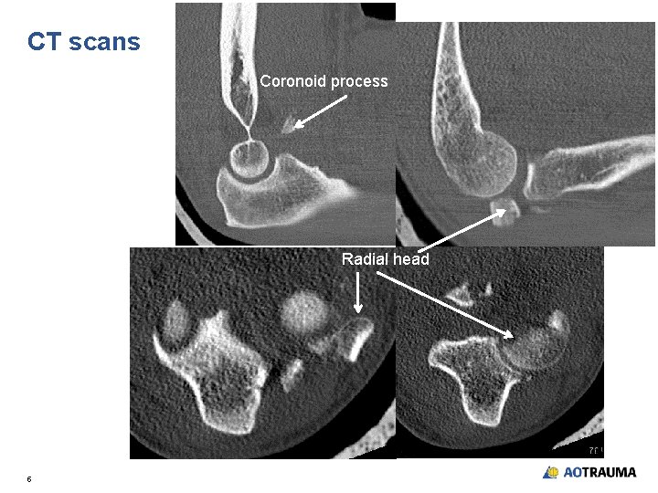 CT scans Coronoid process Radial head 5 