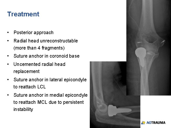 Treatment • Posterior approach • Radial head unreconstructable (more than 4 fragments) • Suture