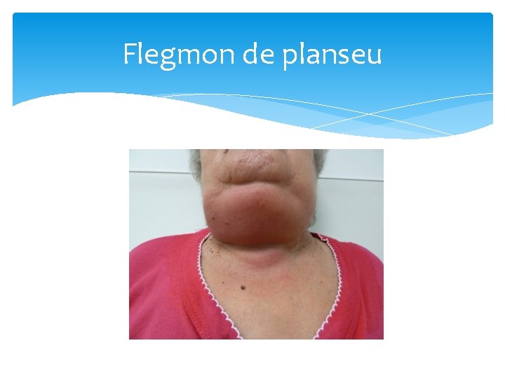 Flegmon de planseu 