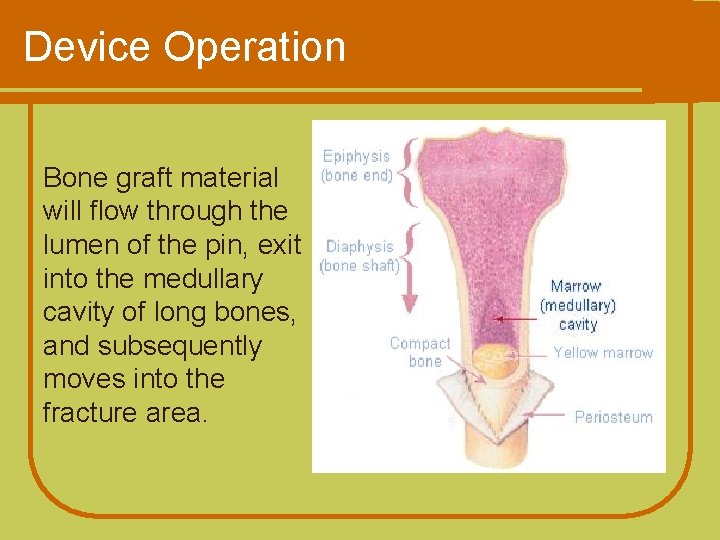 Device Operation Bone graft material will flow through the lumen of the pin, exit