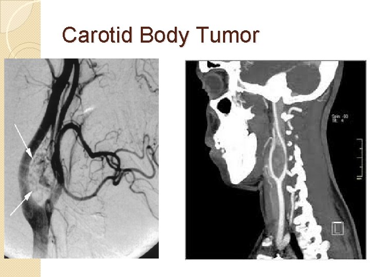 Carotid Body Tumor 