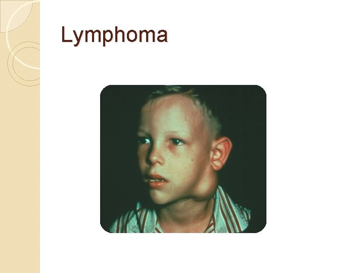 Lymphoma 