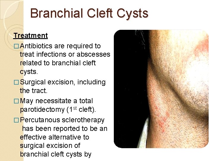 Branchial Cleft Cysts Treatment � Antibiotics are required to treat infections or abscesses related