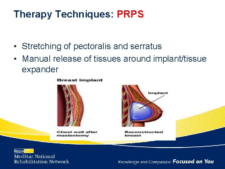 Therapy Techniques: PRPS • Stretching of pectoralis and serratus • Manual release of tissues