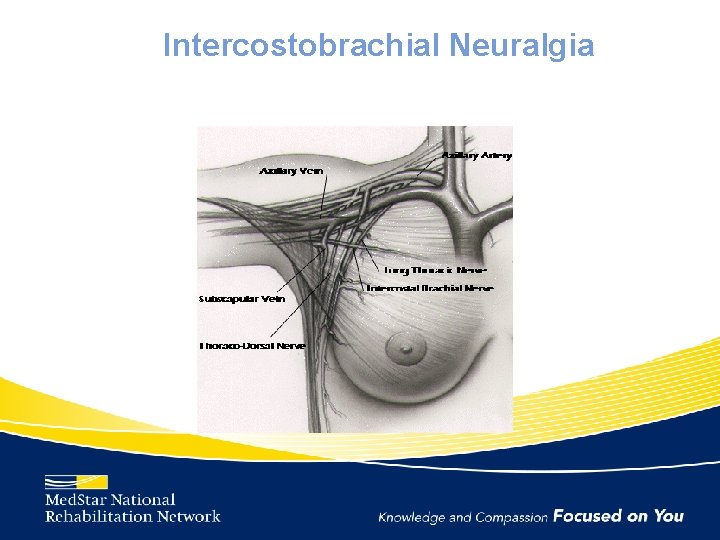 Intercostobrachial Neuralgia 