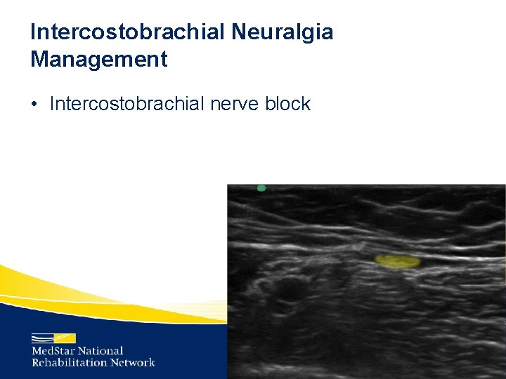 Intercostobrachial Neuralgia Management • Intercostobrachial nerve block 