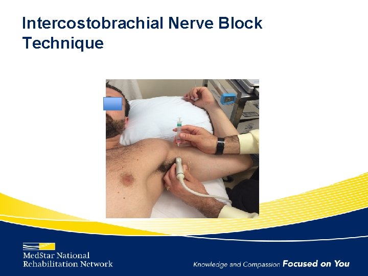 Intercostobrachial Nerve Block Technique 