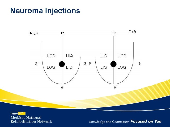 Neuroma Injections 